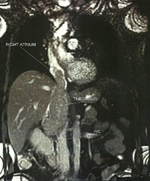 MRI imaging displaying the cavoatrial tumor thrombus.
