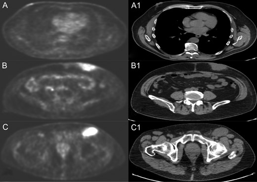 PET and CT scan of right breast nodule (A and A1), left abdominal mass (B and B1) and left inguinal lymph node (C and C1).