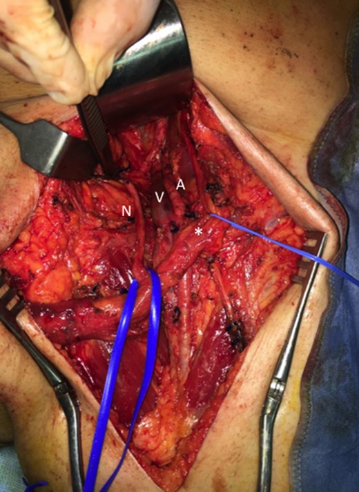 Inguinal region after linfoadenectomy (N, nerve; V, Vein; A, Artery; *spermatic cord).