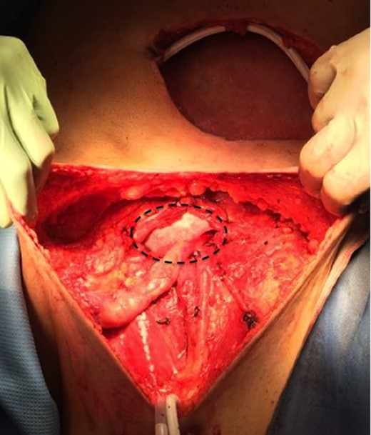 GORE® BIO-A® prosthesis used for reconstruction of the abdominal wall and inguinal canal.