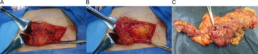 (A) Mucinous mass attached to the subcutaneous tissue. (B) Mucinous mass attached to the omentum that protrudes from the abdominal wall defect. (C) Right colon, with a perforated appendix and a mass in the cecum.