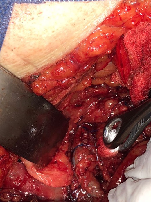 Inferior vena cava lesion repaired.