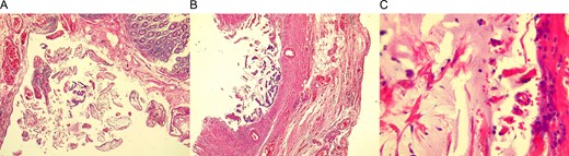 (A) Cecum wall, congestive and infiltrated with mucous material. (B) Appendix base, with atypia of goblet cells. (C) Mucous material covering the appendix base.