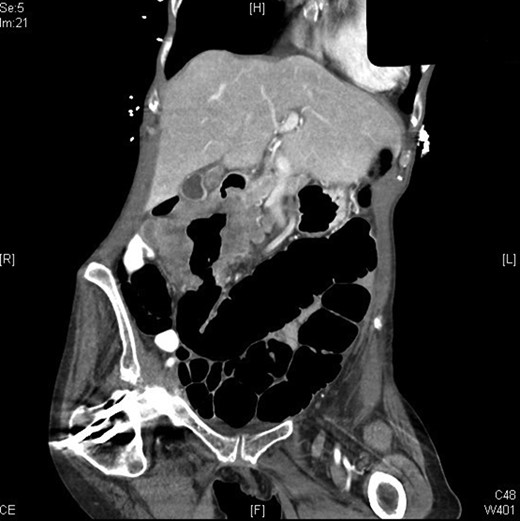 CT abdomen and pelvis (pre-operatively) – axial view.