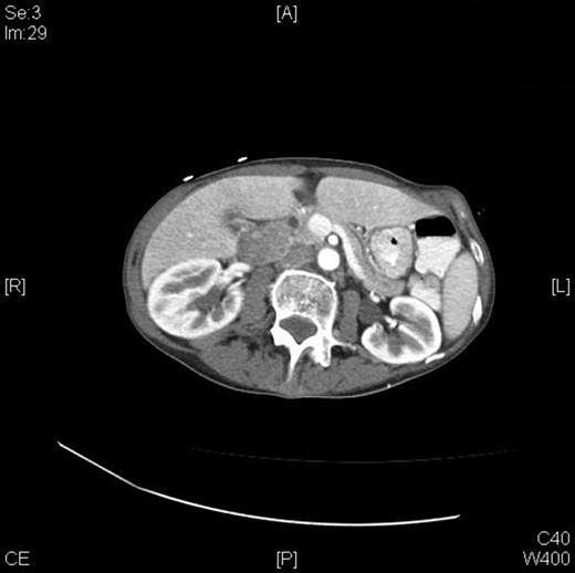 CT abdomen and pelvis (pre-operatively) – transverse view.