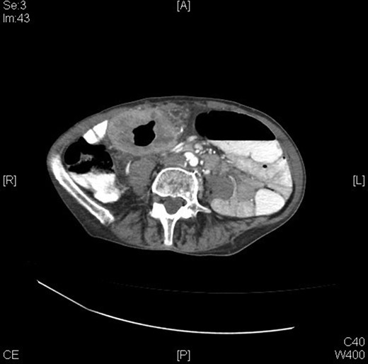 CT abdomen and pelvis (pre-operatively) – transverse view.