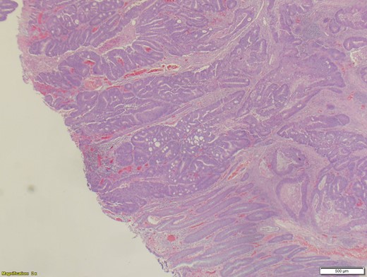 Adenocarcinoma of the ascending colon.