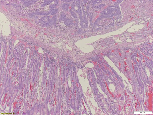 Adenocarcinoma of the duodenum – high power.