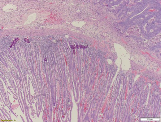 Adenocarcinoma of the duodenum – low power.