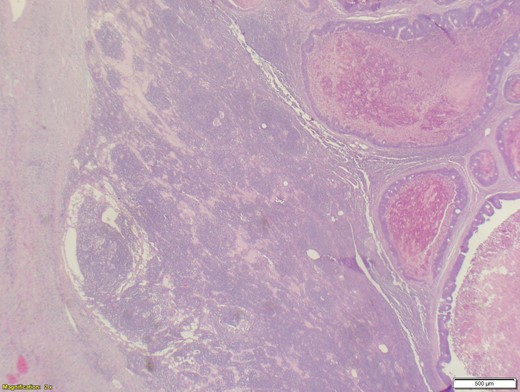Adenocarcinoma of the cystic duct lymph node.