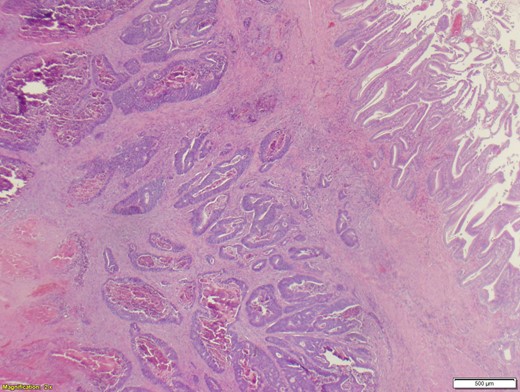 Adenocarcinoma of the gallbladder.