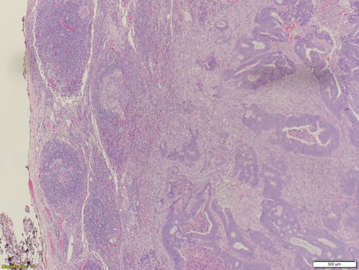 Adenocarcinoma of the adjacent lymph node.