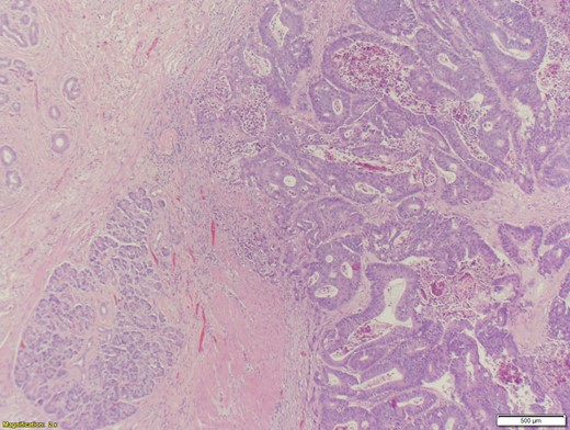 Adenocarcinoma of the head of the pancreas – high power