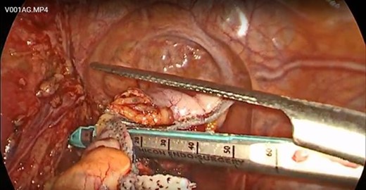 The bowel was transected with the Echelon powered stapler.