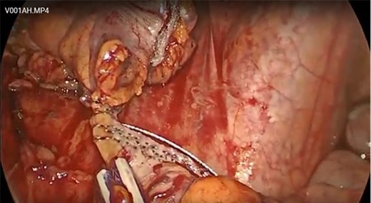 The wire was pushed to the end of the bowel but not transected.