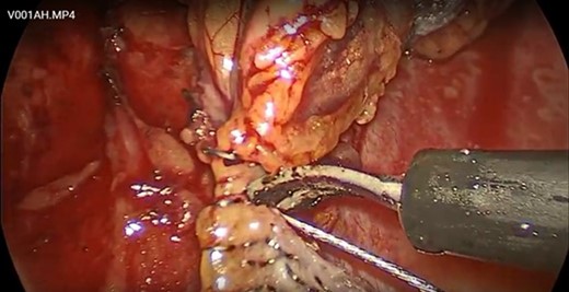Adherent mesentery was dissected free from the snare wire.