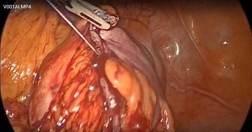The snare wire was seen exiting the proximal bowel staple line.