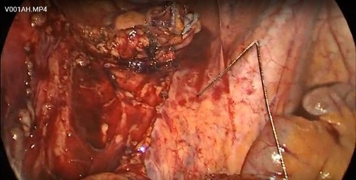 There was a bend in the wire due to the stapler blade but no transection.