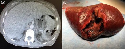 Abdominal computed tomography scan showing splenic abscess (a), the macroscopic view of the splenectomy specimen (b).