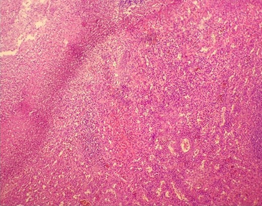 Microscopic view of suppurative inflammation, and abscess formation in the spleen. In the upper left corner fibrin, and most of the abscess formation that necrotized neutrophil leukocytes cause to nuclear debris is seen.
