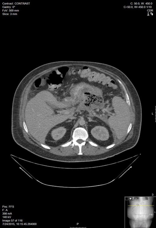 Walled off pancreatic necrosis of admission CT.