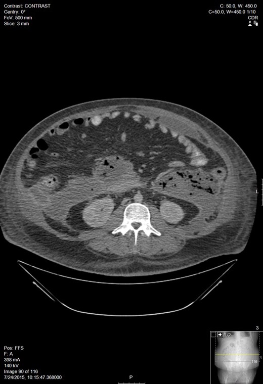 Worsening walled off pancreatic necrosis with extension to the paracolic gutters.