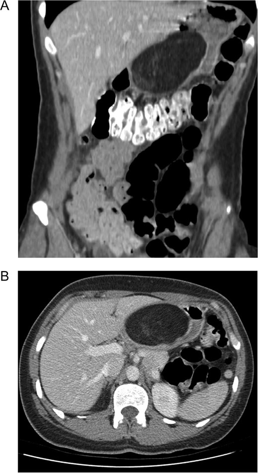 Computer tomography demonstrating a large (9.7 Ă— 7.8 Ă— 4.8 cm3) mural based mass extending along the posterior wall of the lesser curve of the stomach, effacing the lumen. (A) Coronal. (B) Axial. The mass contains predominantly fat signal with areas of hazy internal enhancement. No pathological lymphadenopathy was noted.