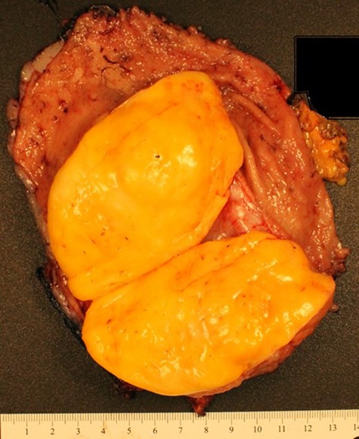 Gross pathology: partial gastrectomy specimen composed of distal portion of stomach and duodenum. Adipocytic neoplasm encapsulated and well circumscribed within the submucosa of the antrum. No gross or microscopic evidence of tumor necrosis. The tumor does not extend past the muscularis propria.