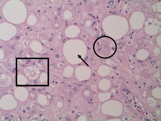 Histopathology of gastrectomy specimen (Ă—200): Brown fat cells (circle) and scattered immature adipocytes (square) intermixed with Lipoma-like adipocytes (arrow), the later including. No mitotic figures or nuclear hyperchromasia identified.