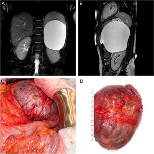 (A, B) Coronal and sagittal T2 weighted, fat suppressed MR image of the abdomen showing displacement of the spleen as well as the left kidney by the adrenal tumor. (C) Intra-operative finding showing close proximity of the cystic lesion to the left colonic flexure. (D) Surgically excised cystic tumor together with the left adrenal gland.