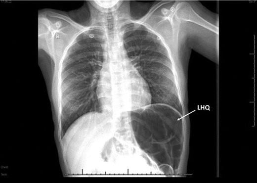 Chest x-rays; absence of gastric bubbles at the left hypochondria (LHQ; white arrow) that was replaced with bowel loops.