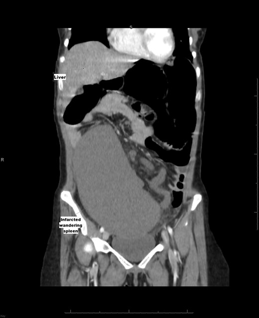 Computed tomography of the abdomen and pelvis with IV contrast shows a non-enhancing (infarcted) spleen (dotted arrow) that has completely migrated to the right side of the abdomen and pelvis.