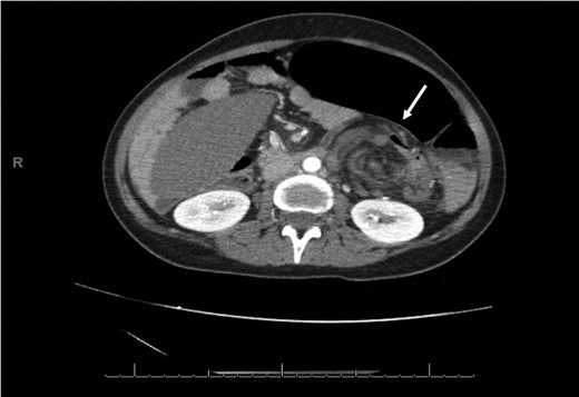 An axial CT of the upper level of the abdomen shows a corkscrew-like soft tissue density (white arrow) indicating twisted splenic vessels surrounded by peritoneal ligaments and fats forming a whirly appearance with alterative lucent and dense bands (a whirl sign), is a pathognomonic CT findings of torsion.
