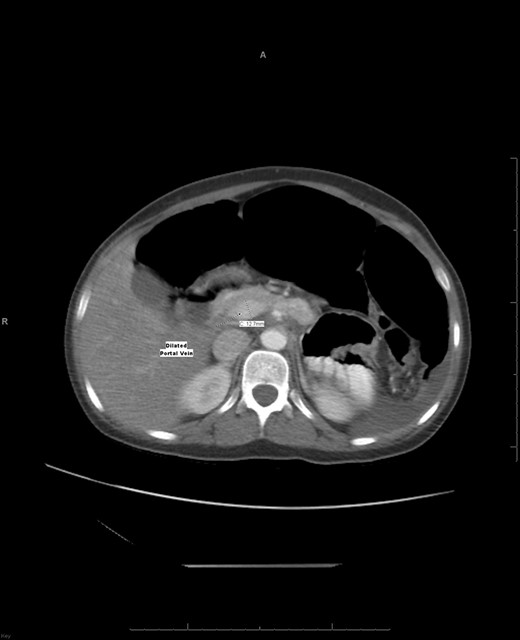 An axial CT shows a widening portal vein 12.7 mm in diameter indicating portal hypertension with multiple dilated portal veins seen at the liver parenchyma.