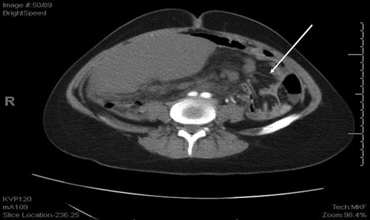 An axial CT shows dilated engorged mesenteric vessels (white arrow) indicating mesenteric varices.