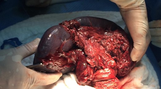 Intraoperative view of an infarcted wandering spleen with a whirly appearance of splenic pedicles surrounded by peritoneal ligaments and fats.