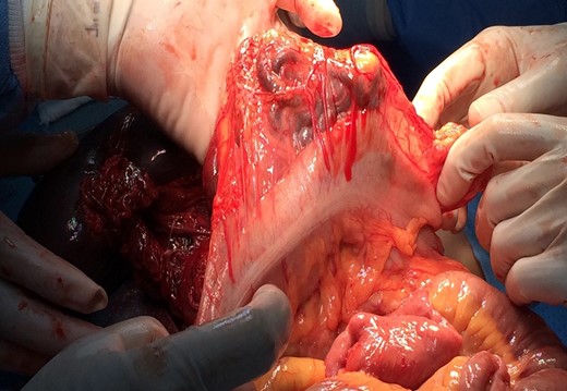 Intraoperative view of dilated tortious tributaries of the superior mesenteric vein adjacent to the handled transverse colon.