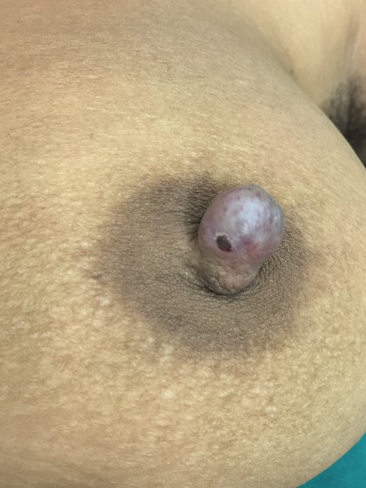 Photograph showing the lesion on superior aspect of left nipple.