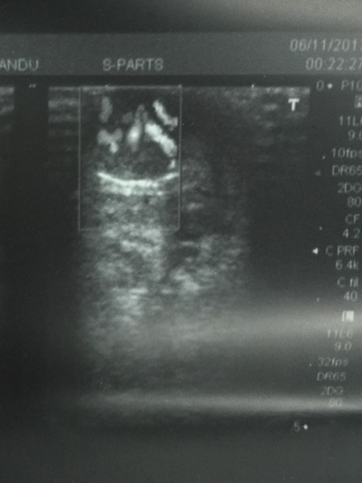 Ultrasound image showing the marked vascularity of lesion.