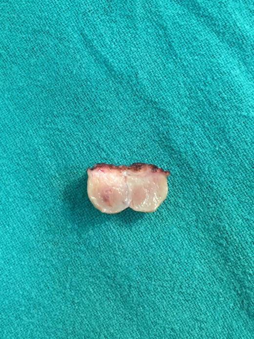 Photograph of the cut section after excision of the lesion.