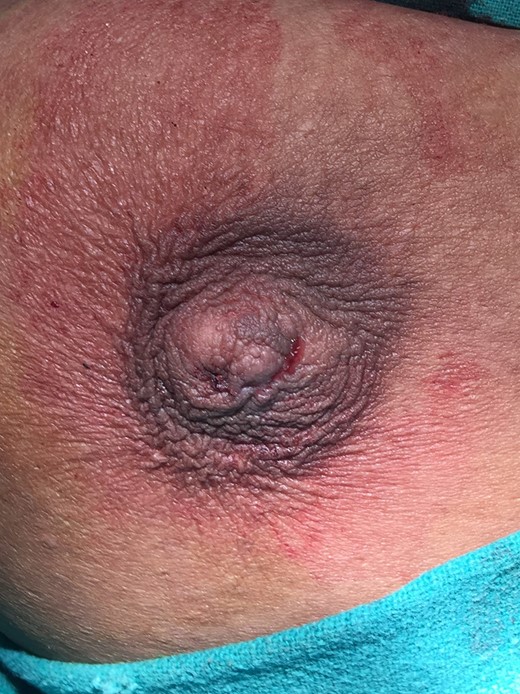 Photograph of the nipple after excision.