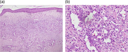 Histopathology showing stratified squamous epithelial lining with proliferation of capillaries in underlying stroma (H & E stain). (a) 10× Magnification (b) 40× Magnification.