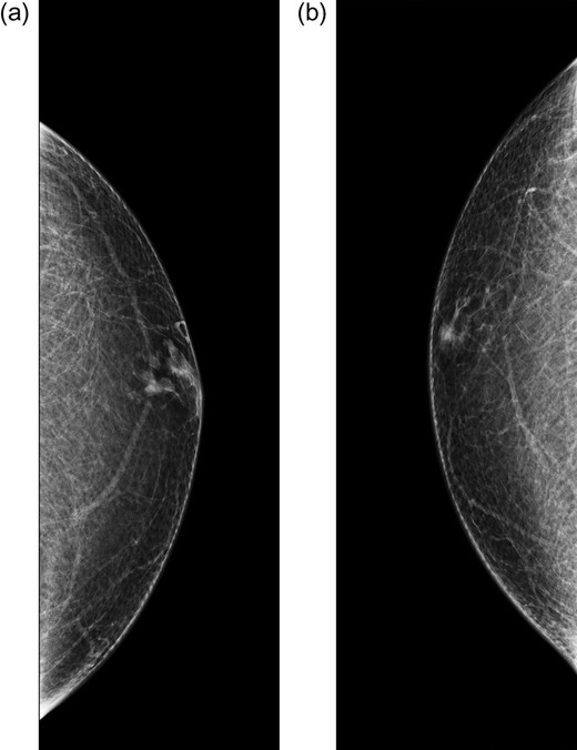 Diagnostic mammogram of the left (a) and right (b) breast demonstrates mild bilateral gynecomastia without discrete mass.