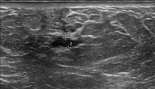 Ultrasound of the left breast at the 6:00 region reveals a mildly hypoechoic mass with ductal extension.