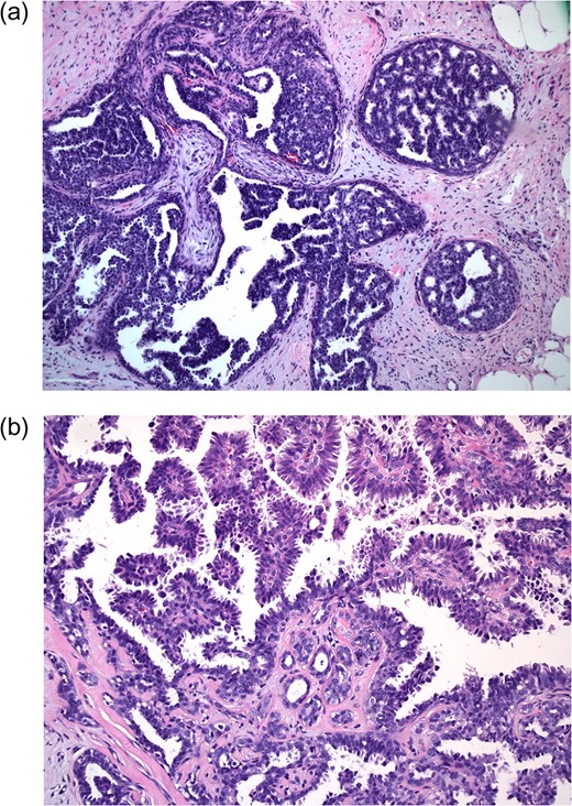 Excisional biopsy at 10× magnification (a) shows neoplastic cells within ducts; 20× magnification (b) demonstrates cribriform and micropapillary features (samples stained with hematoxylin and eosin).