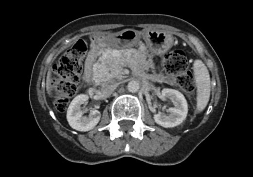 Axial slice of portal-venous phase CT scan demonstrating lesion in the head of pancreas.