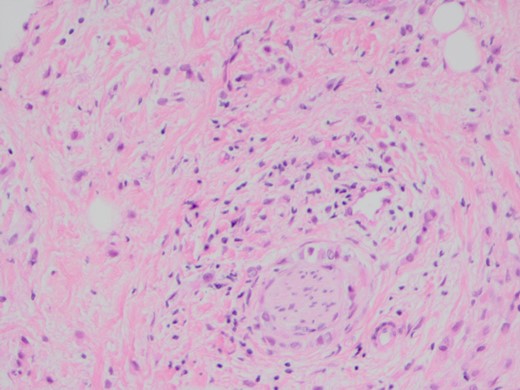 H and E stain demonstrating poorly differentiated carcinoma with perineural invasion.
