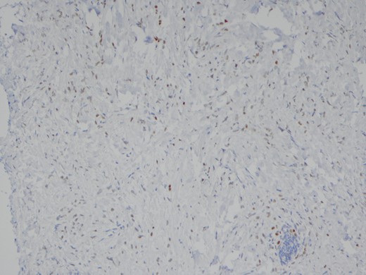 The poorly differentiated carcinoma shows nuclear positivity for oestrogen receptor (IPX).