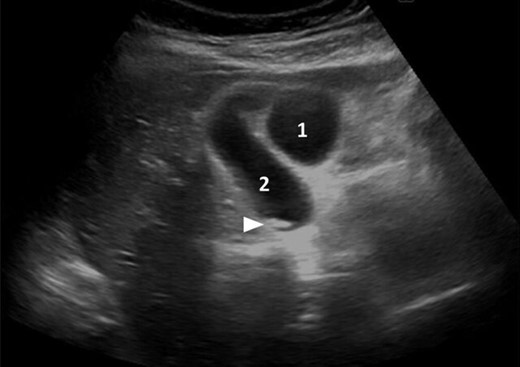 Ultrasonography showing the two distinct gallbladders (1 and 2) with sludge in one of them (arrowhead).