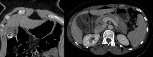 CT scan in frontal and axial slices showing two distinct gallbladders (1 and 2) with cholelithiasus in one of them.